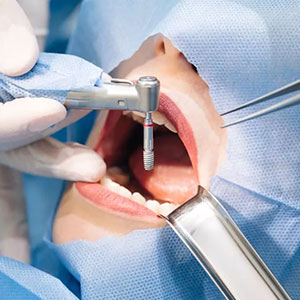 کاشت ایمپلنت پانچ